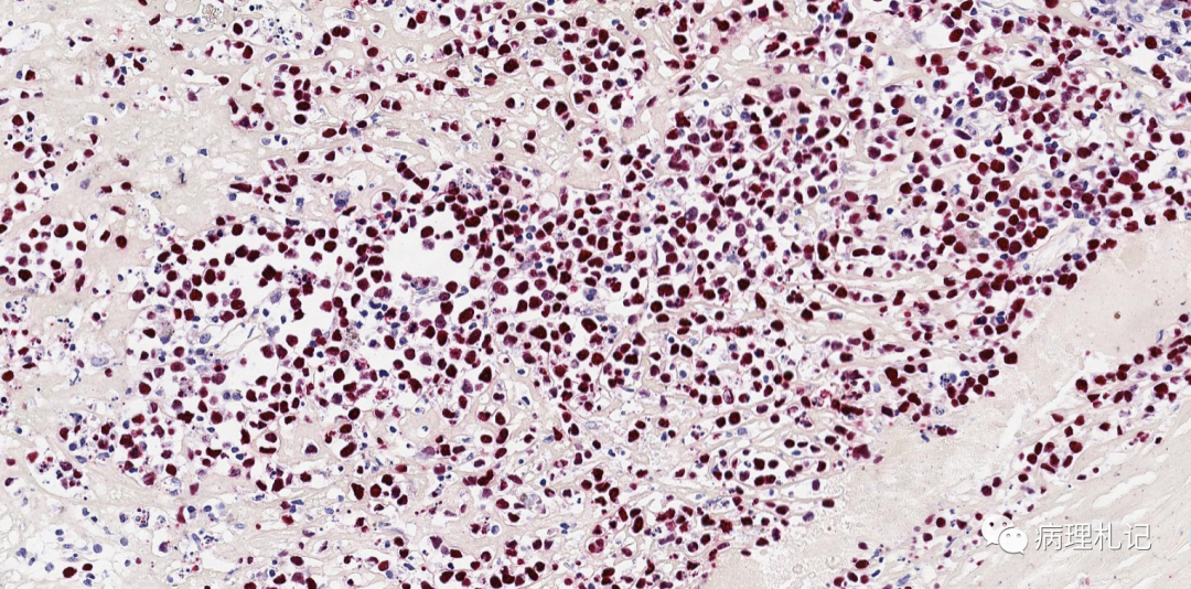 纤维蛋白相关的弥漫性大b细胞淋巴瘤的镜下观