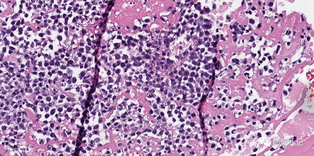 纤维蛋白相关的弥漫性大b细胞淋巴瘤的镜下观