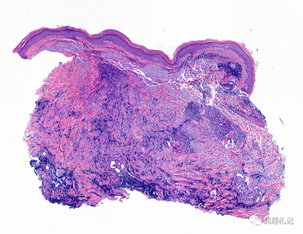 印象是基底细胞癌_医学界-助力医生临床决策和职业成长