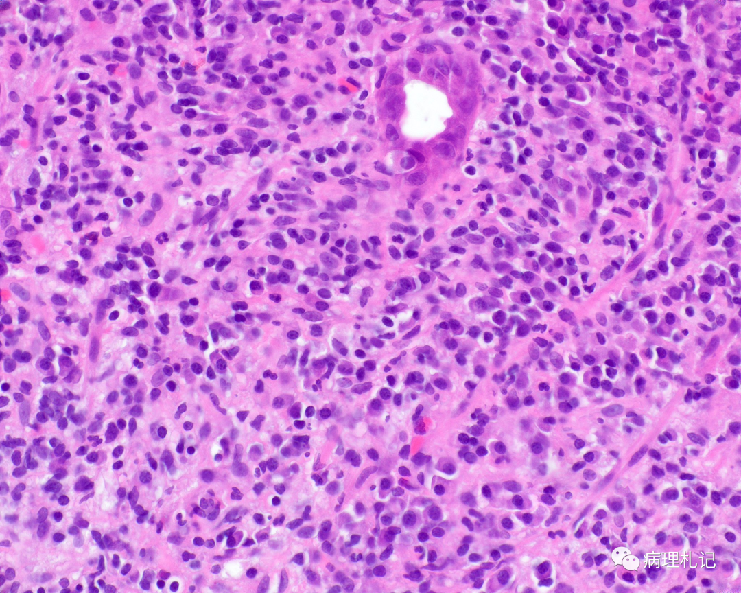 结肠附近皮样囊肿合并乳腺外paget病的有趣病例_医学