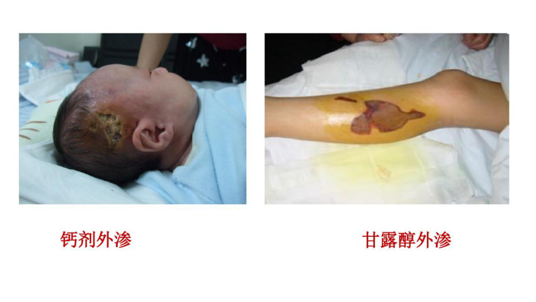 药物外渗是热敷还是冷敷？细说药物外渗