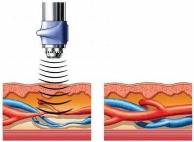 隔物灸有什么作用【新技术】没有子弹的枪——冲击波，让你远离疼痛_https://www.jmylbn.com_新闻资讯_第16张