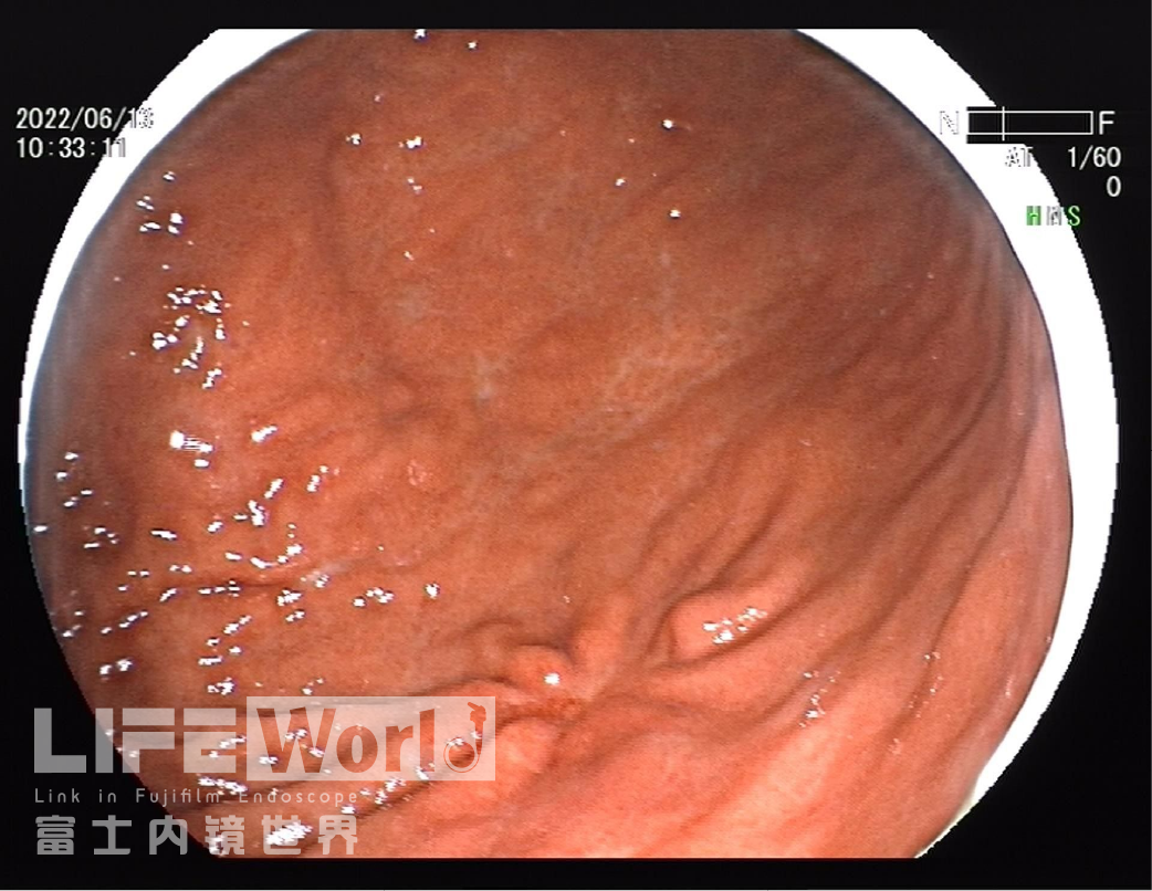 富士胃镜英文怎么写病例分享 ｜ 周环：一例不易判断的胃体病变的诊治分享（富士内镜早癌读片会）_https://www.jmylbn.com_新闻资讯_第5张