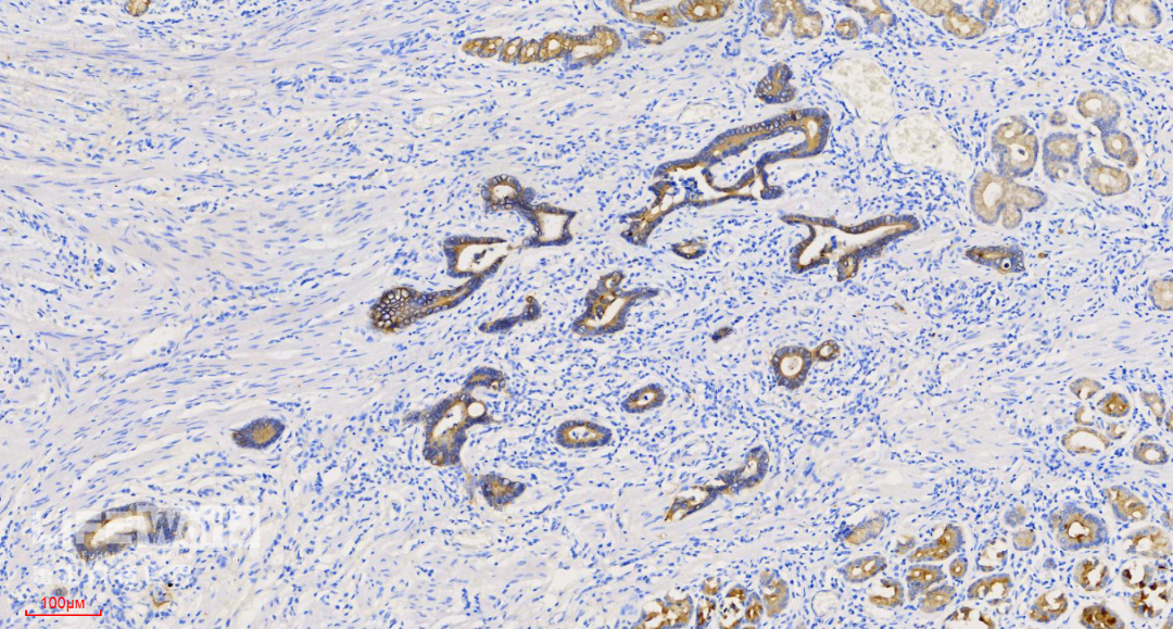 富士胃镜英文怎么写病例分享 ｜ 周环：一例不易判断的胃体病变的诊治分享（富士内镜早癌读片会）_https://www.jmylbn.com_新闻资讯_第49张