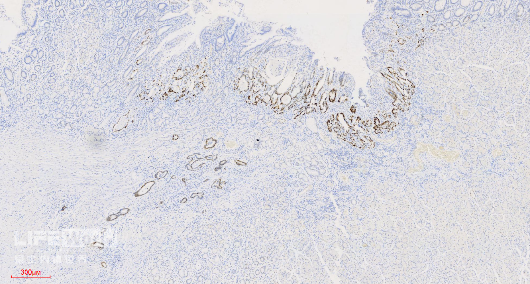 富士胃镜英文怎么写病例分享 ｜ 周环：一例不易判断的胃体病变的诊治分享（富士内镜早癌读片会）_https://www.jmylbn.com_新闻资讯_第51张