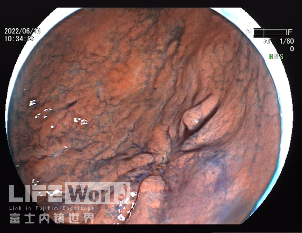 富士胃镜英文怎么写病例分享 ｜ 周环：一例不易判断的胃体病变的诊治分享（富士内镜早癌读片会）_https://www.jmylbn.com_新闻资讯_第23张