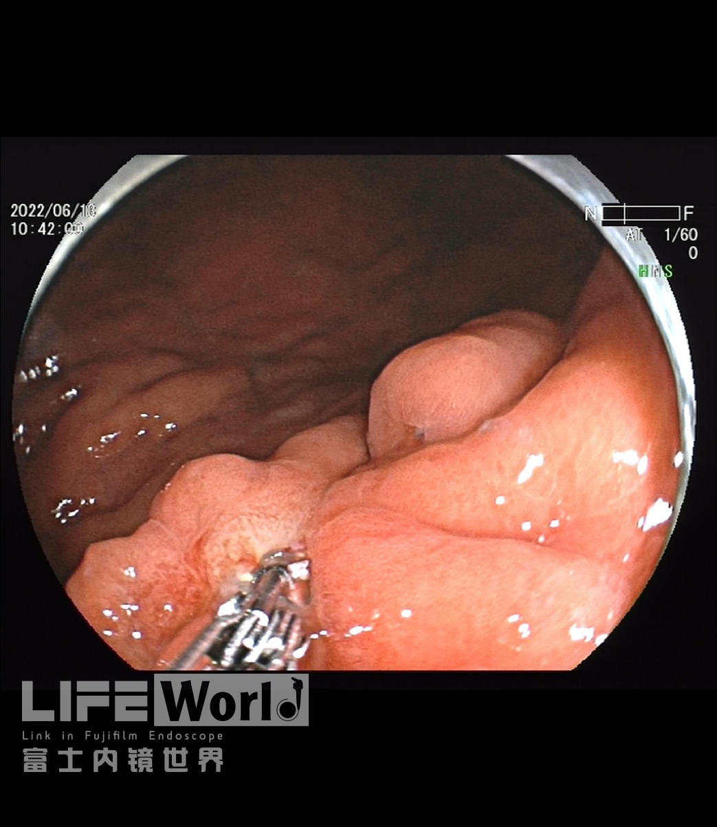 富士胃镜英文怎么写病例分享 ｜ 周环：一例不易判断的胃体病变的诊治分享（富士内镜早癌读片会）_https://www.jmylbn.com_新闻资讯_第31张