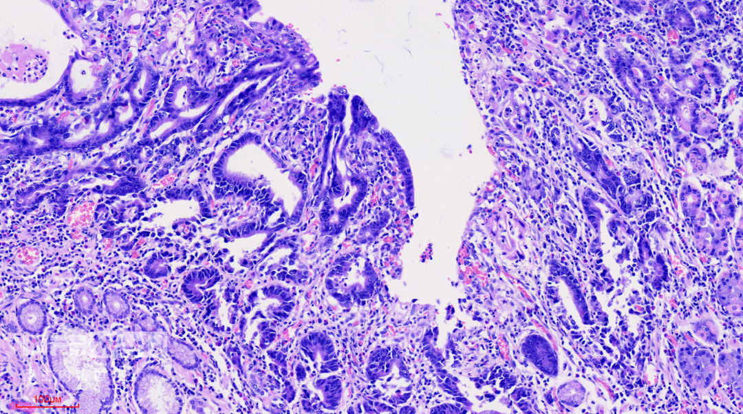 富士胃镜英文怎么写病例分享 ｜ 周环：一例不易判断的胃体病变的诊治分享（富士内镜早癌读片会）_https://www.jmylbn.com_新闻资讯_第44张