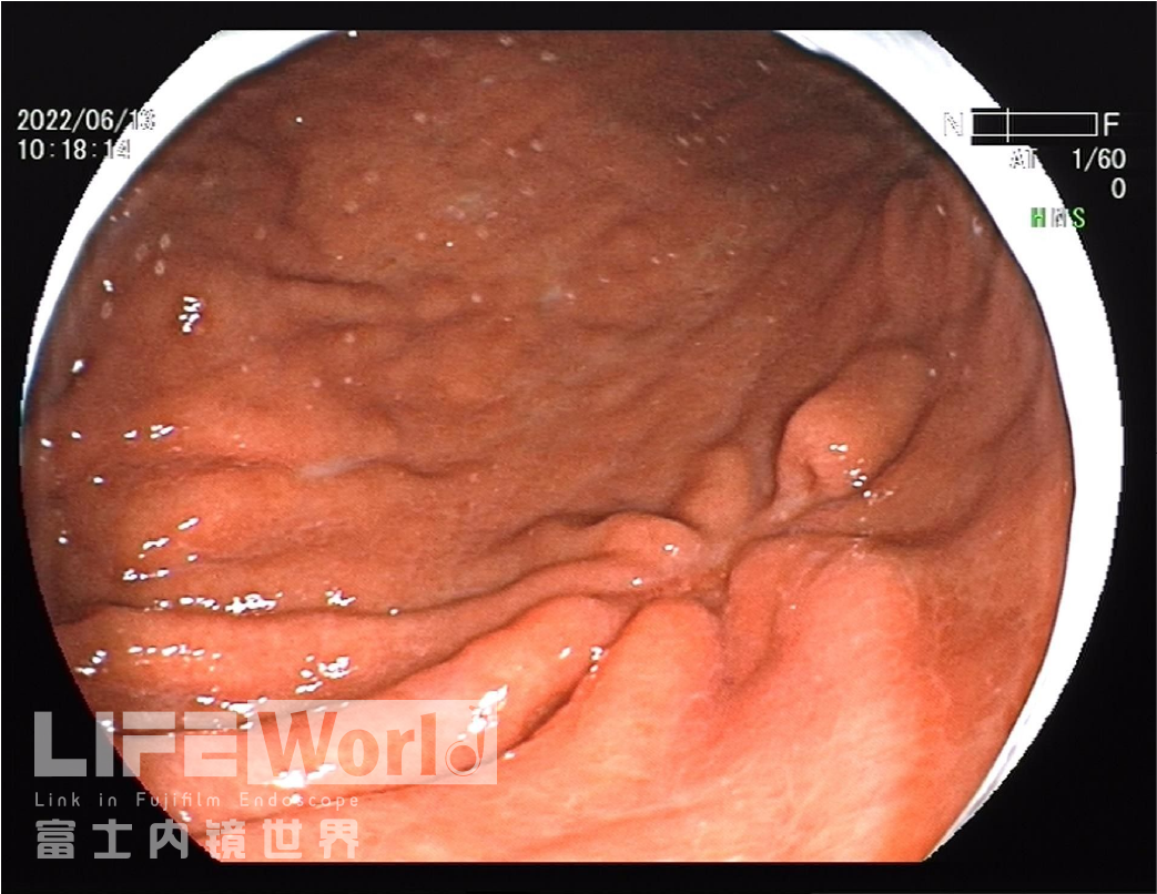 富士胃镜英文怎么写病例分享 ｜ 周环：一例不易判断的胃体病变的诊治分享（富士内镜早癌读片会）_https://www.jmylbn.com_新闻资讯_第29张