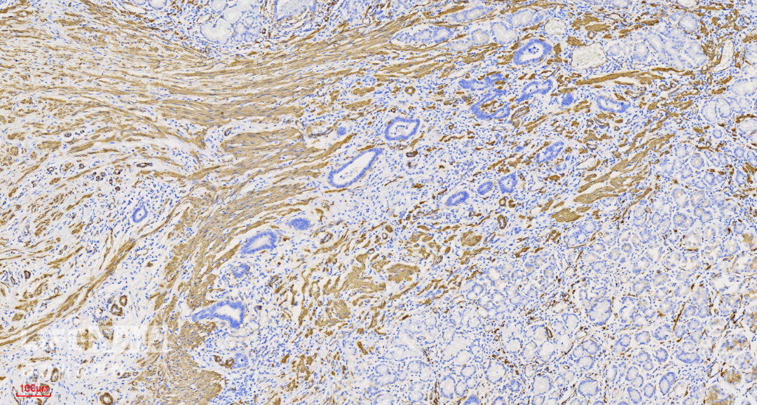 富士胃镜英文怎么写病例分享 ｜ 周环：一例不易判断的胃体病变的诊治分享（富士内镜早癌读片会）_https://www.jmylbn.com_新闻资讯_第53张