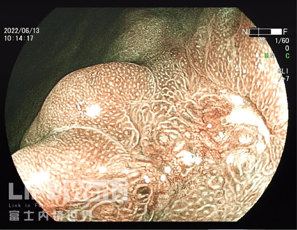 富士胃镜英文怎么写病例分享 ｜ 周环：一例不易判断的胃体病变的诊治分享（富士内镜早癌读片会）_https://www.jmylbn.com_新闻资讯_第16张