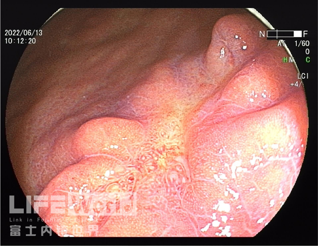 富士胃镜英文怎么写病例分享 ｜ 周环：一例不易判断的胃体病变的诊治分享（富士内镜早癌读片会）_https://www.jmylbn.com_新闻资讯_第9张