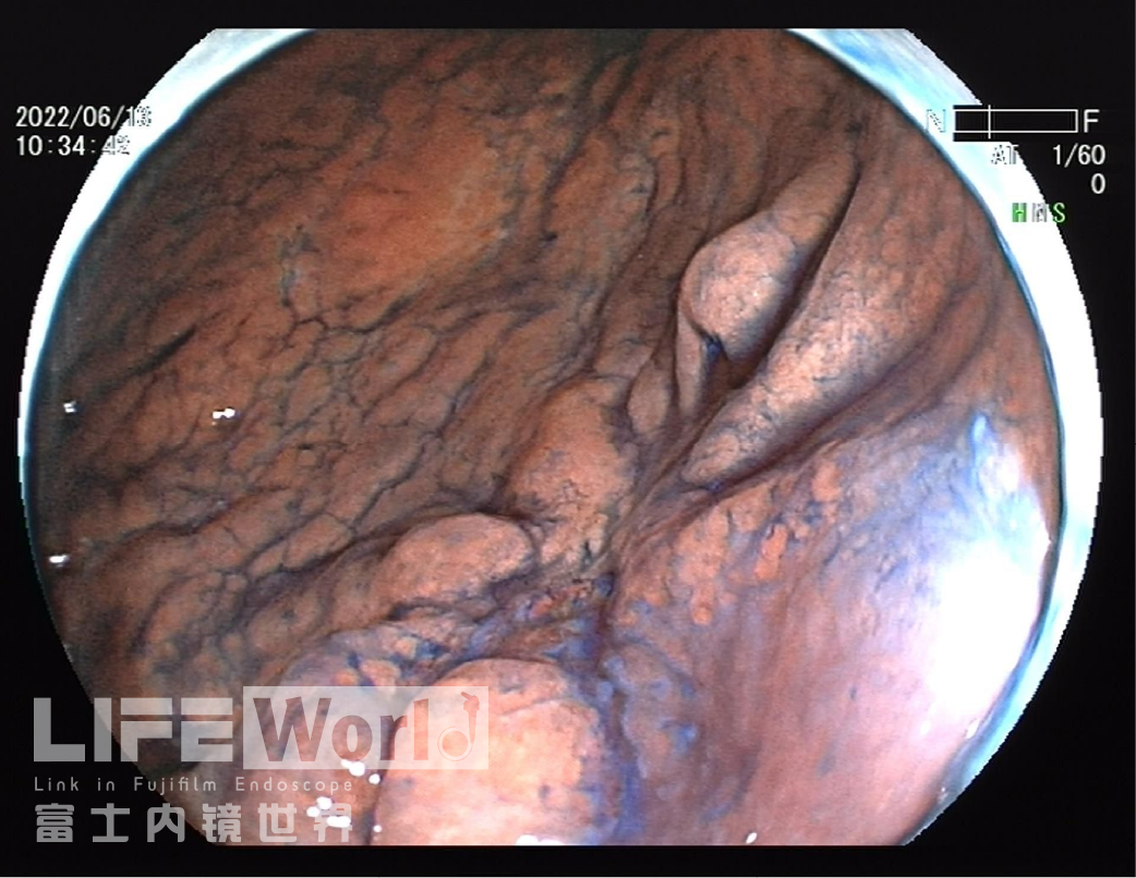 富士胃镜英文怎么写病例分享 ｜ 周环：一例不易判断的胃体病变的诊治分享（富士内镜早癌读片会）_https://www.jmylbn.com_新闻资讯_第22张