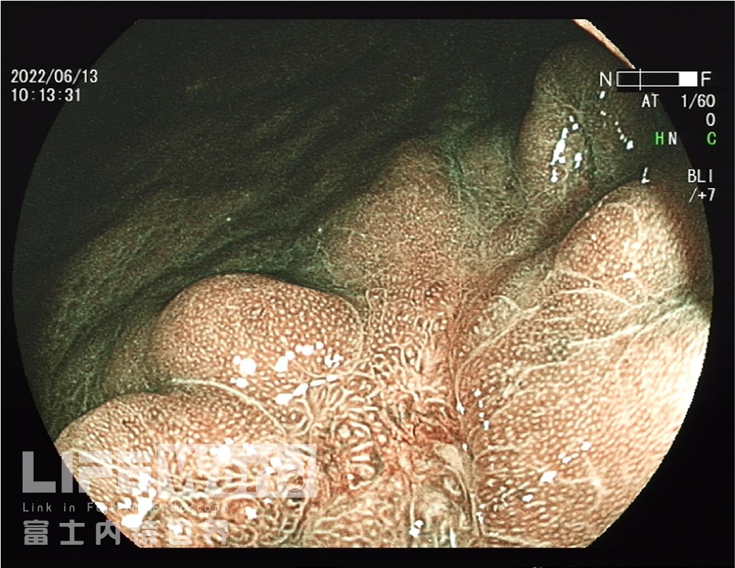 富士胃镜英文怎么写病例分享 ｜ 周环：一例不易判断的胃体病变的诊治分享（富士内镜早癌读片会）_https://www.jmylbn.com_新闻资讯_第12张