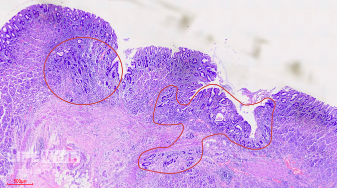 富士胃镜英文怎么写病例分享 ｜ 周环：一例不易判断的胃体病变的诊治分享（富士内镜早癌读片会）_https://www.jmylbn.com_新闻资讯_第43张