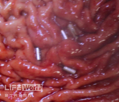 富士胃镜英文怎么写病例分享 ｜ 周环：一例不易判断的胃体病变的诊治分享（富士内镜早癌读片会）_https://www.jmylbn.com_新闻资讯_第37张