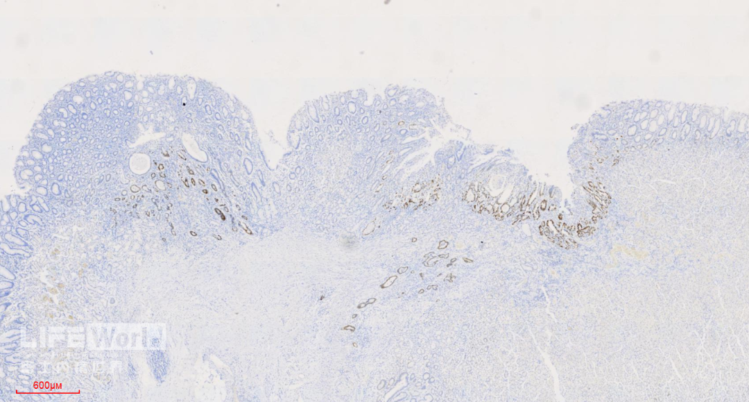 富士胃镜英文怎么写病例分享 ｜ 周环：一例不易判断的胃体病变的诊治分享（富士内镜早癌读片会）_https://www.jmylbn.com_新闻资讯_第50张