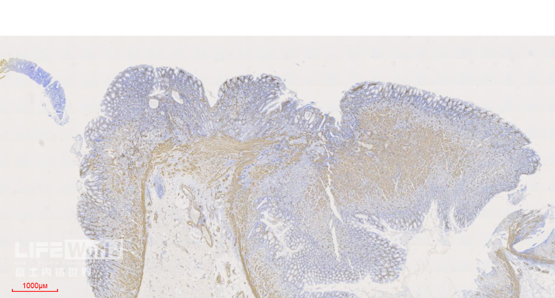 富士胃镜英文怎么写病例分享 ｜ 周环：一例不易判断的胃体病变的诊治分享（富士内镜早癌读片会）_https://www.jmylbn.com_新闻资讯_第52张