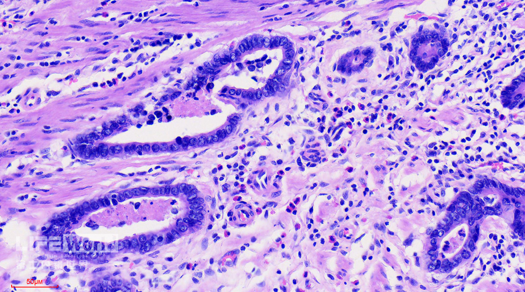 富士胃镜英文怎么写病例分享 ｜ 周环：一例不易判断的胃体病变的诊治分享（富士内镜早癌读片会）_https://www.jmylbn.com_新闻资讯_第47张