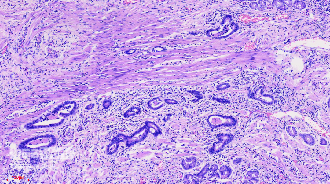 富士胃镜英文怎么写病例分享 ｜ 周环：一例不易判断的胃体病变的诊治分享（富士内镜早癌读片会）_https://www.jmylbn.com_新闻资讯_第46张