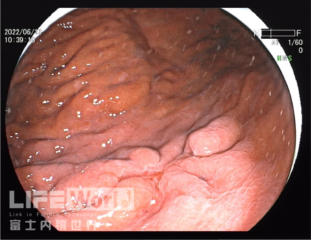 富士胃镜英文怎么写病例分享 ｜ 周环：一例不易判断的胃体病变的诊治分享（富士内镜早癌读片会）_https://www.jmylbn.com_新闻资讯_第24张