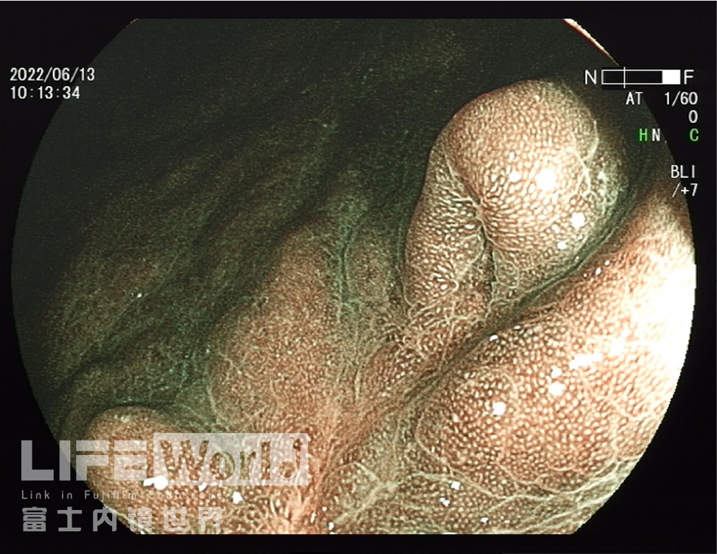 富士胃镜英文怎么写病例分享 ｜ 周环：一例不易判断的胃体病变的诊治分享（富士内镜早癌读片会）_https://www.jmylbn.com_新闻资讯_第13张