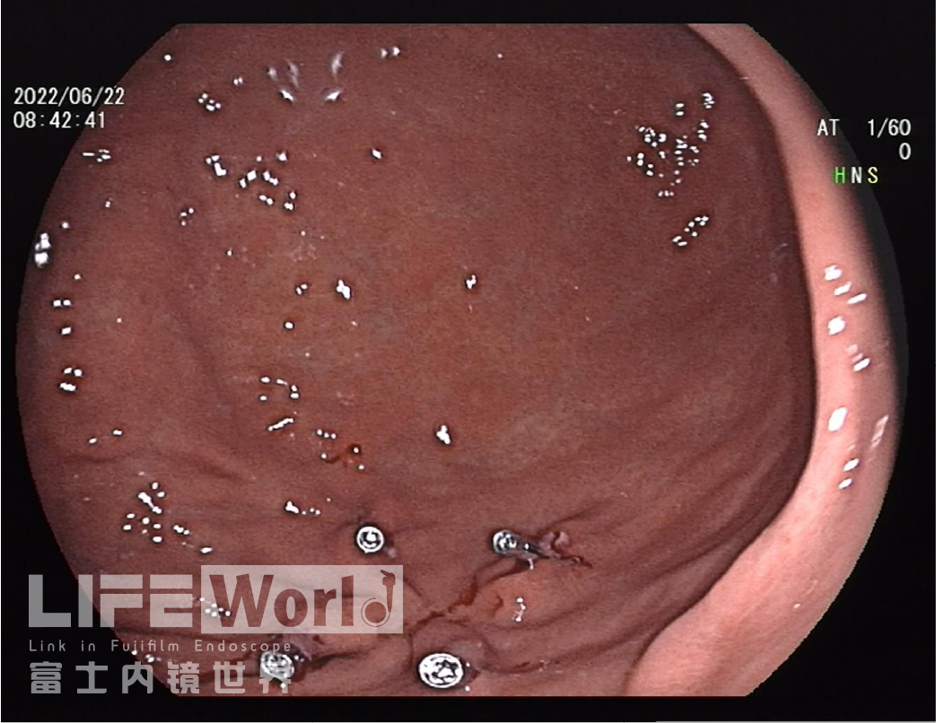 富士胃镜英文怎么写病例分享 ｜ 周环：一例不易判断的胃体病变的诊治分享（富士内镜早癌读片会）_https://www.jmylbn.com_新闻资讯_第35张