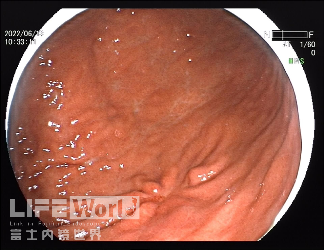 富士胃镜英文怎么写病例分享 ｜ 周环：一例不易判断的胃体病变的诊治分享（富士内镜早癌读片会）_https://www.jmylbn.com_新闻资讯_第28张