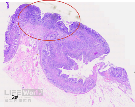 富士胃镜英文怎么写病例分享 ｜ 周环：一例不易判断的胃体病变的诊治分享（富士内镜早癌读片会）_https://www.jmylbn.com_新闻资讯_第42张