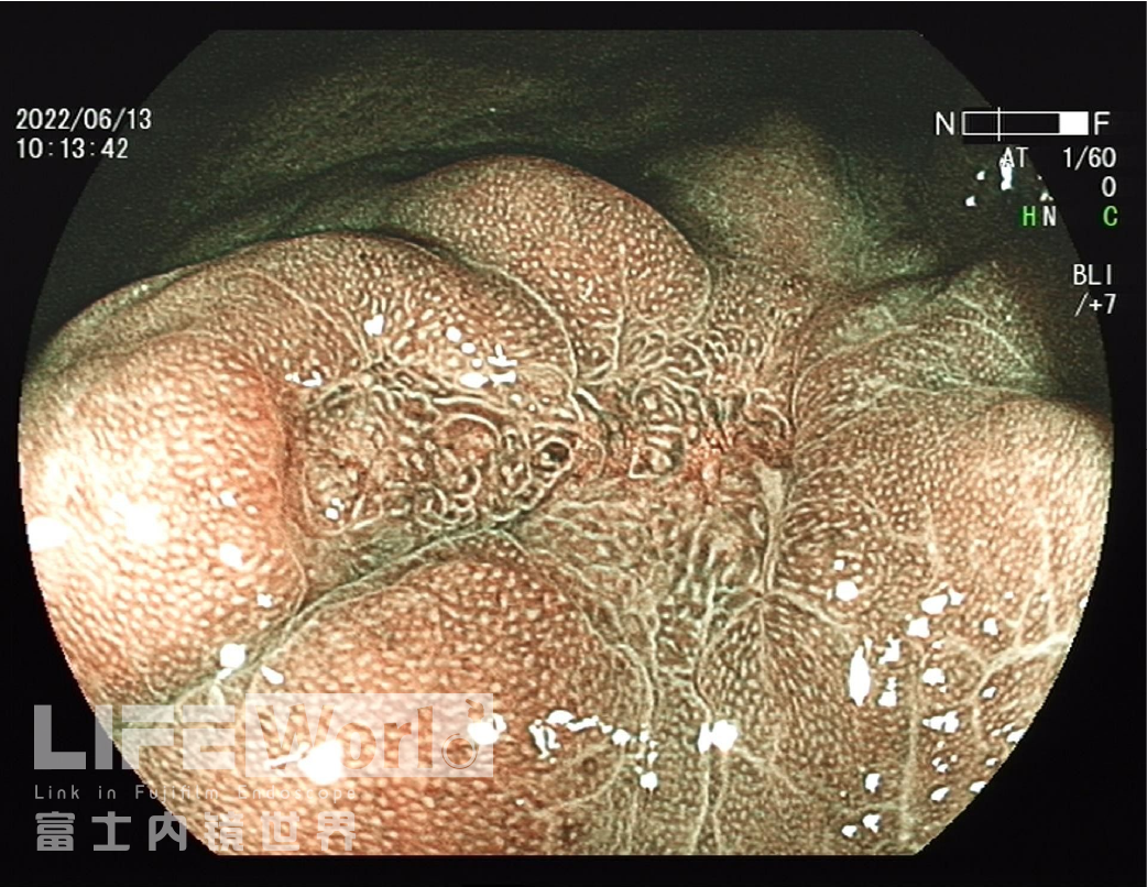 富士胃镜英文怎么写病例分享 ｜ 周环：一例不易判断的胃体病变的诊治分享（富士内镜早癌读片会）_https://www.jmylbn.com_新闻资讯_第11张