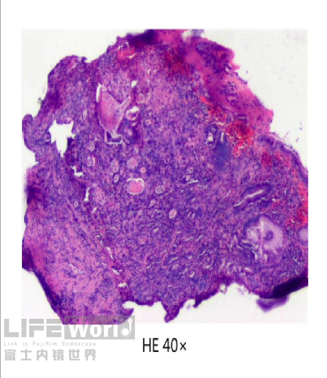 富士胃镜英文怎么写病例分享 ｜ 周环：一例不易判断的胃体病变的诊治分享（富士内镜早癌读片会）_https://www.jmylbn.com_新闻资讯_第32张