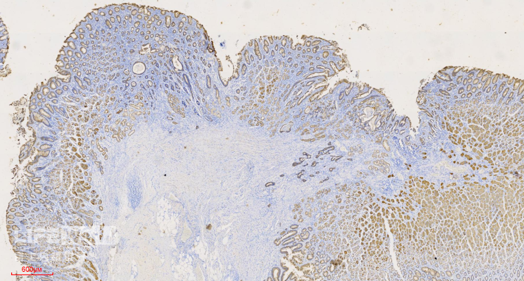 富士胃镜英文怎么写病例分享 ｜ 周环：一例不易判断的胃体病变的诊治分享（富士内镜早癌读片会）_https://www.jmylbn.com_新闻资讯_第48张