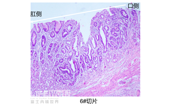 富士胃镜英文怎么写病例分享 ｜ 周环：一例不易判断的胃体病变的诊治分享（富士内镜早癌读片会）_https://www.jmylbn.com_新闻资讯_第41张