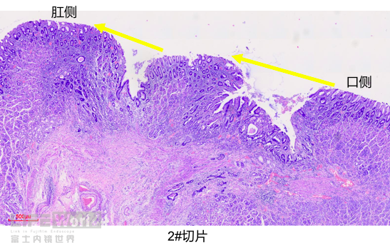 富士胃镜英文怎么写病例分享 ｜ 周环：一例不易判断的胃体病变的诊治分享（富士内镜早癌读片会）_https://www.jmylbn.com_新闻资讯_第40张