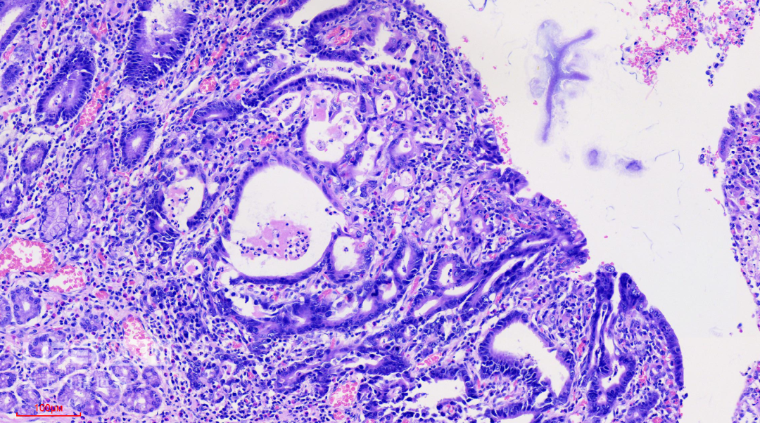 富士胃镜英文怎么写病例分享 ｜ 周环：一例不易判断的胃体病变的诊治分享（富士内镜早癌读片会）_https://www.jmylbn.com_新闻资讯_第45张