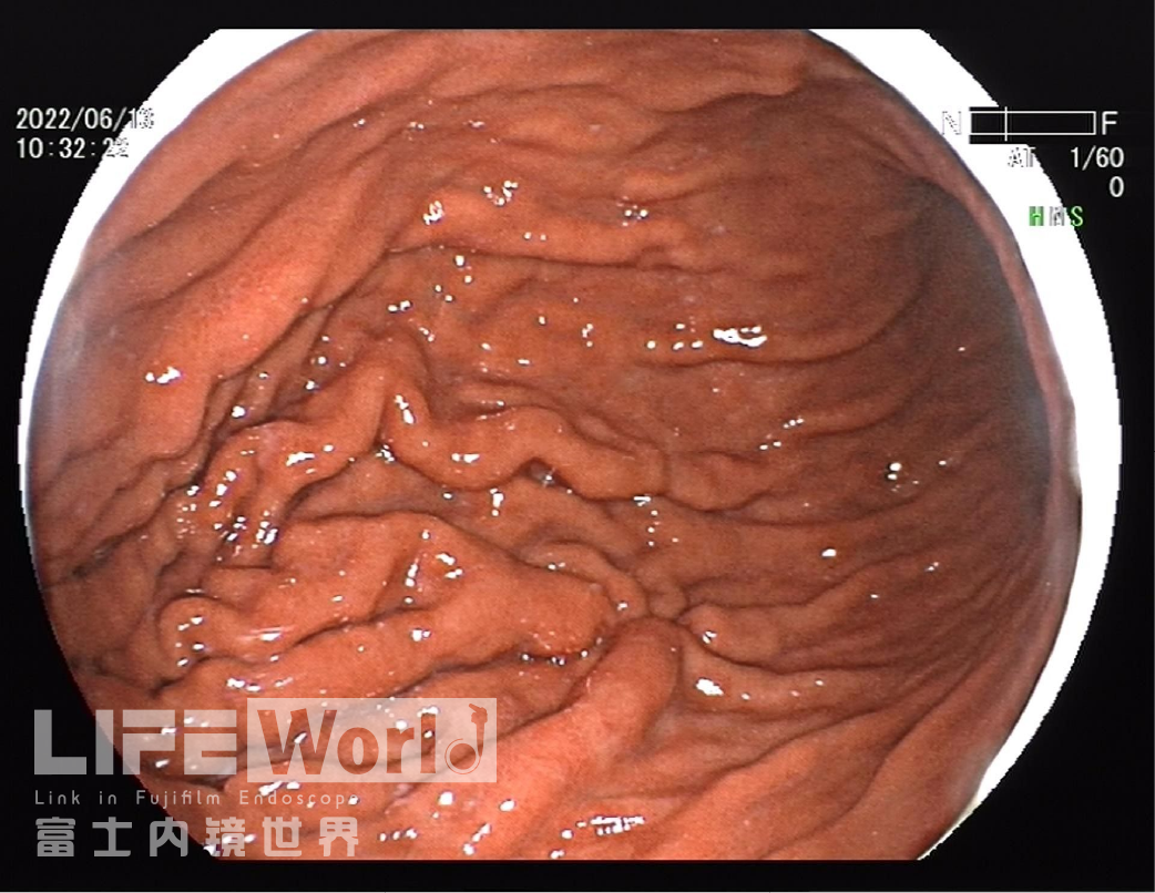 富士胃镜英文怎么写病例分享 ｜ 周环：一例不易判断的胃体病变的诊治分享（富士内镜早癌读片会）_https://www.jmylbn.com_新闻资讯_第4张