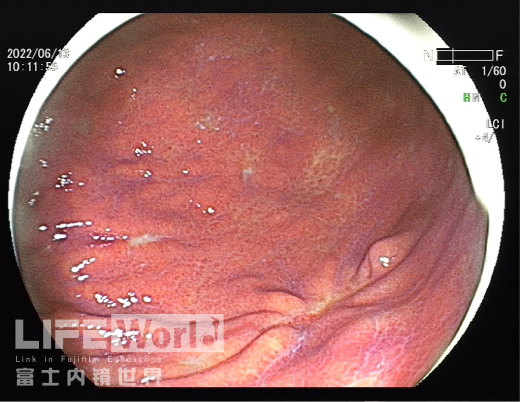 富士胃镜英文怎么写病例分享 ｜ 周环：一例不易判断的胃体病变的诊治分享（富士内镜早癌读片会）_https://www.jmylbn.com_新闻资讯_第7张