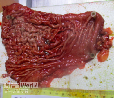 富士胃镜英文怎么写病例分享 ｜ 周环：一例不易判断的胃体病变的诊治分享（富士内镜早癌读片会）_https://www.jmylbn.com_新闻资讯_第36张