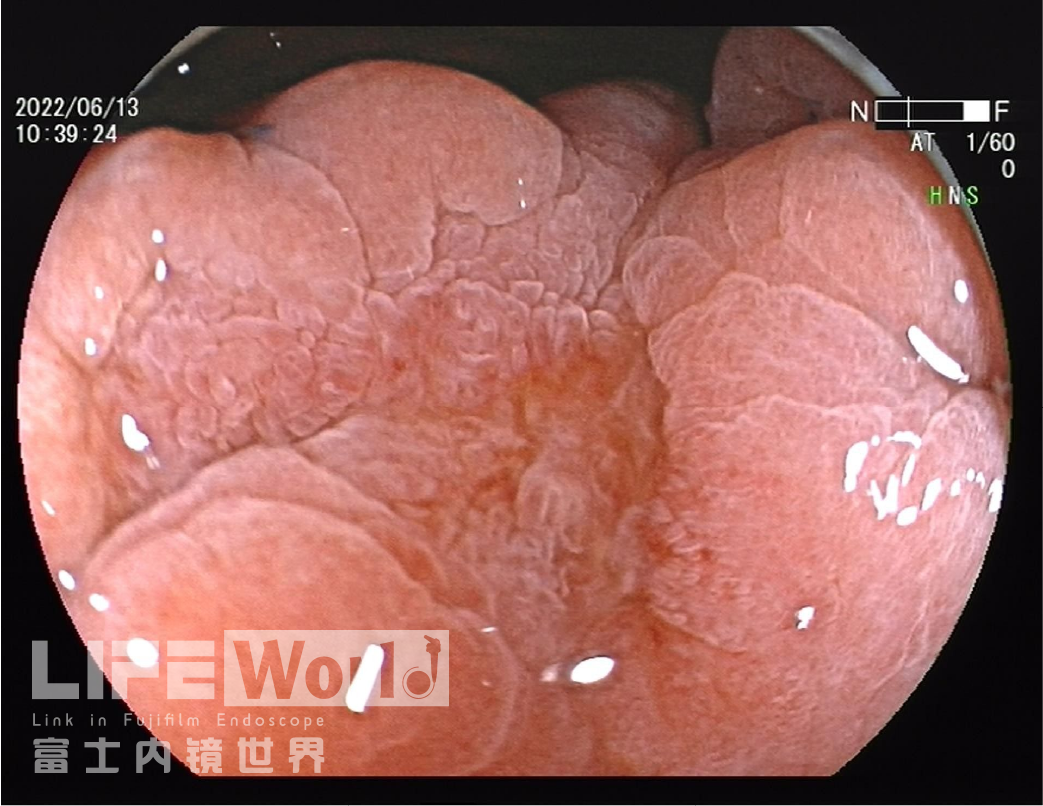 富士胃镜英文怎么写病例分享 ｜ 周环：一例不易判断的胃体病变的诊治分享（富士内镜早癌读片会）_https://www.jmylbn.com_新闻资讯_第25张