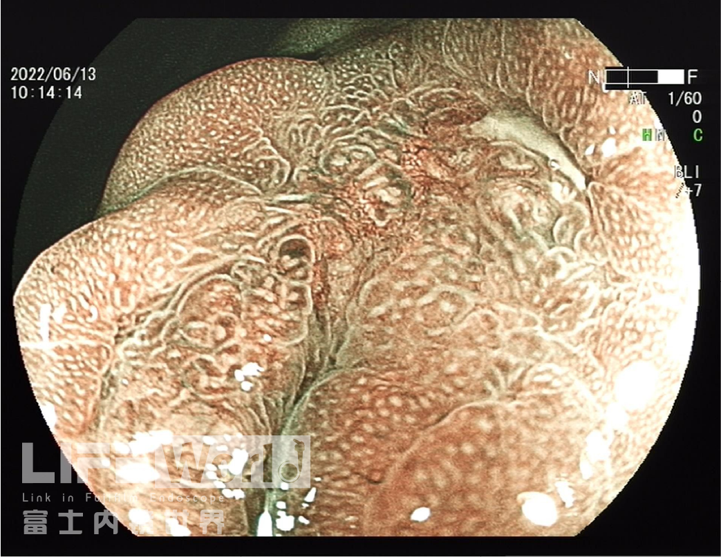 富士胃镜英文怎么写病例分享 ｜ 周环：一例不易判断的胃体病变的诊治分享（富士内镜早癌读片会）_https://www.jmylbn.com_新闻资讯_第15张