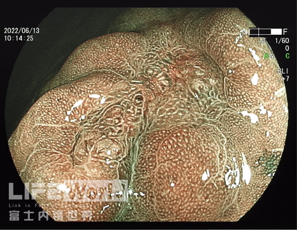 富士胃镜英文怎么写病例分享 ｜ 周环：一例不易判断的胃体病变的诊治分享（富士内镜早癌读片会）_https://www.jmylbn.com_新闻资讯_第14张