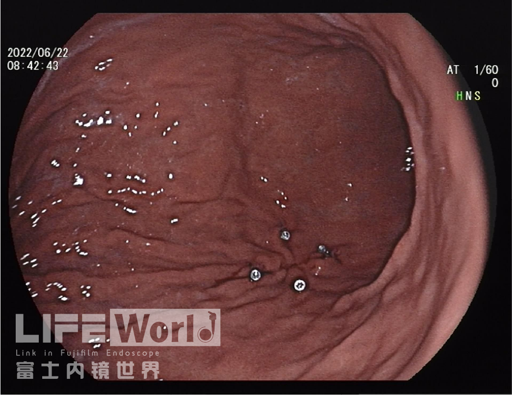 富士胃镜英文怎么写病例分享 ｜ 周环：一例不易判断的胃体病变的诊治分享（富士内镜早癌读片会）_https://www.jmylbn.com_新闻资讯_第34张