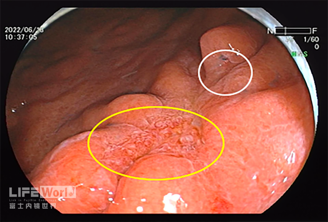 富士胃镜英文怎么写病例分享 ｜ 周环：一例不易判断的胃体病变的诊治分享（富士内镜早癌读片会）_https://www.jmylbn.com_新闻资讯_第27张