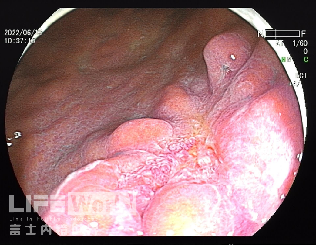 富士胃镜英文怎么写病例分享 ｜ 周环：一例不易判断的胃体病变的诊治分享（富士内镜早癌读片会）_https://www.jmylbn.com_新闻资讯_第26张