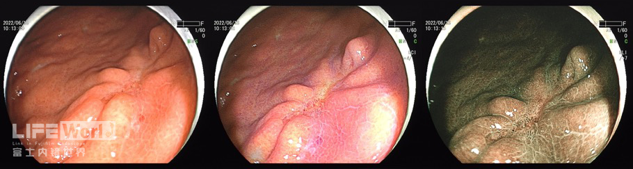 富士胃镜英文怎么写病例分享 ｜ 周环：一例不易判断的胃体病变的诊治分享（富士内镜早癌读片会）_https://www.jmylbn.com_新闻资讯_第10张