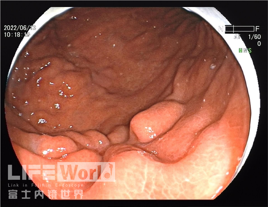 富士胃镜英文怎么写病例分享 ｜ 周环：一例不易判断的胃体病变的诊治分享（富士内镜早癌读片会）_https://www.jmylbn.com_新闻资讯_第30张