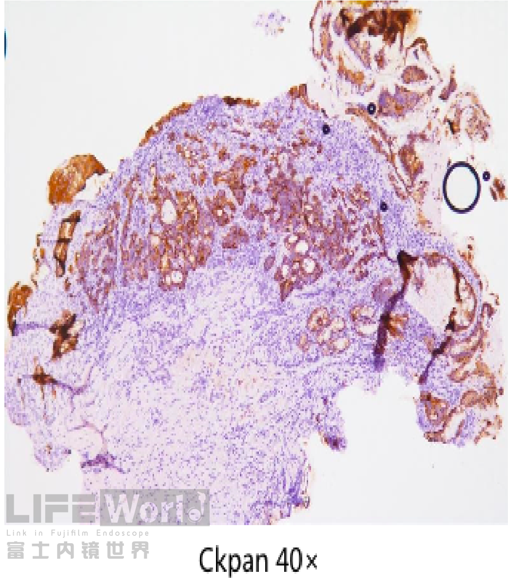 富士胃镜英文怎么写病例分享 ｜ 周环：一例不易判断的胃体病变的诊治分享（富士内镜早癌读片会）_https://www.jmylbn.com_新闻资讯_第33张