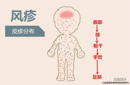 先天性风疹综合征(如何预防先天性风疹综合征）(图1)