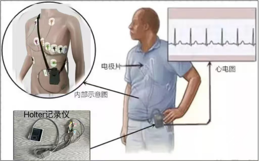 contec心电图机怎么用动态心电图：心脏的24小时“贴身保镖” ——时刻守护心脏健康_https://www.jmylbn.com_新闻资讯_第10张