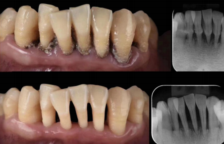 牙周治疗仪怎么做牙周欧乐华牙周治疗仪_https://www.jmylbn.com_新闻资讯_第9张